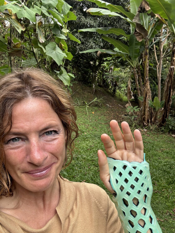 woman holds up a broken hand in green brace
